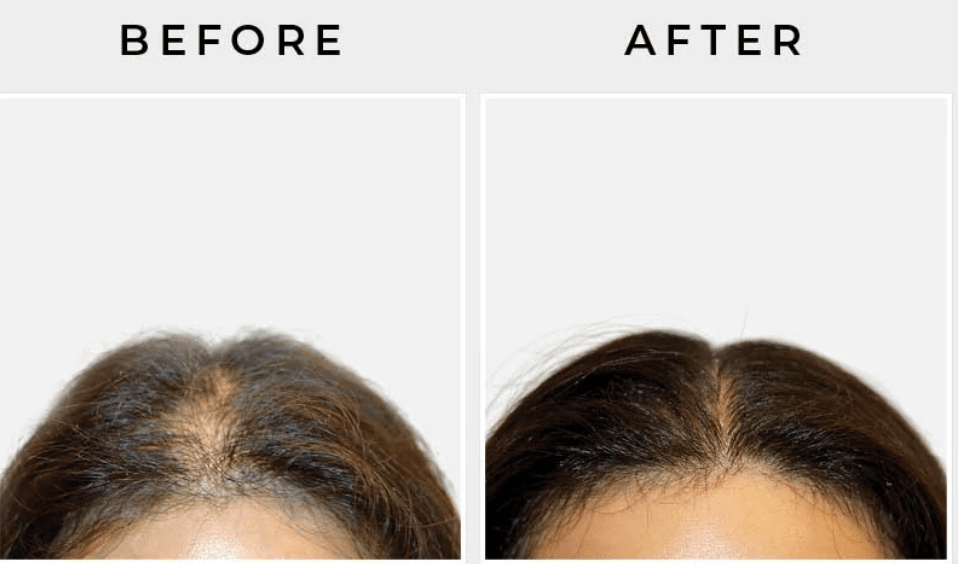 The List of 10 Vitamin Deficiencies Causing Hair Loss