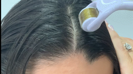 Derma Roller For Hair LossTreatment - YouTube